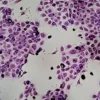Morfologia delle cellule cancerose